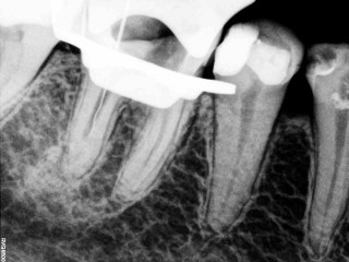 przed leczeniem endodontycznym